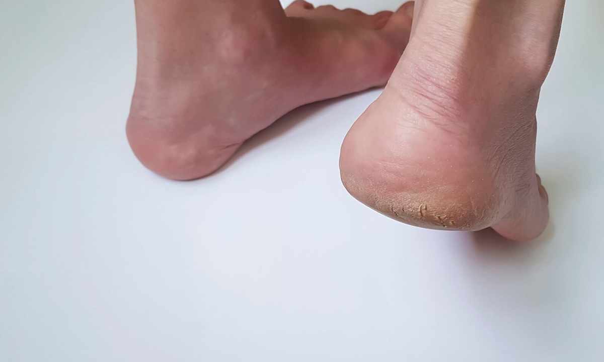How to remove callosities on heels
